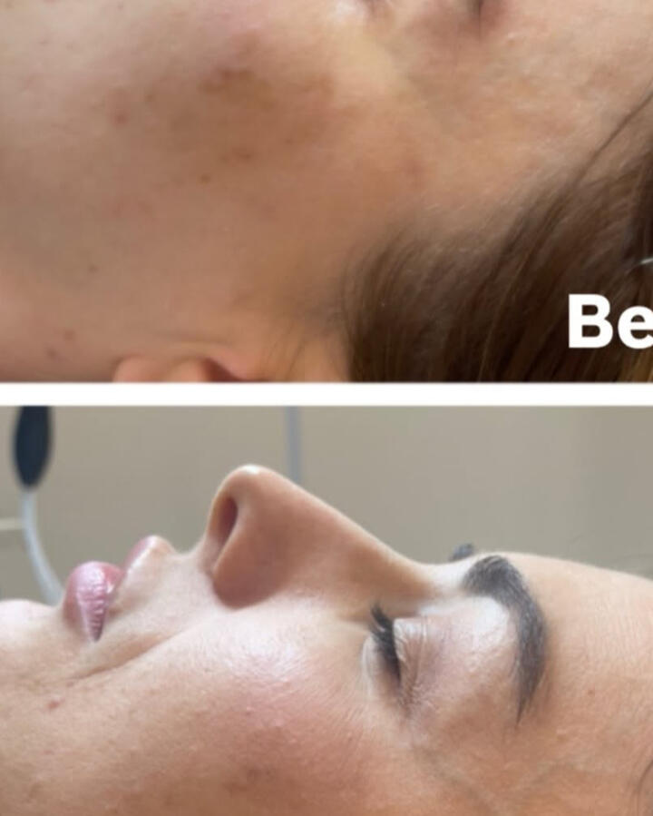 Rezultat real - tratament facial personalizat
